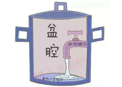 盆腔积液是怎么回事？白带午夜小视频网站厂家提醒早了解早预防