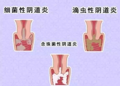 全自动阴道分泌物午夜精品无码免费视频厂家提醒您还在拖延吗，还在等阴道炎自愈吗？